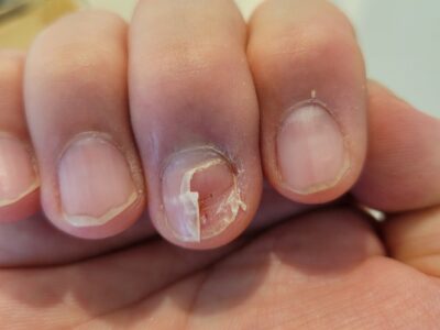 After 2 months (nail clipped for pain relief)